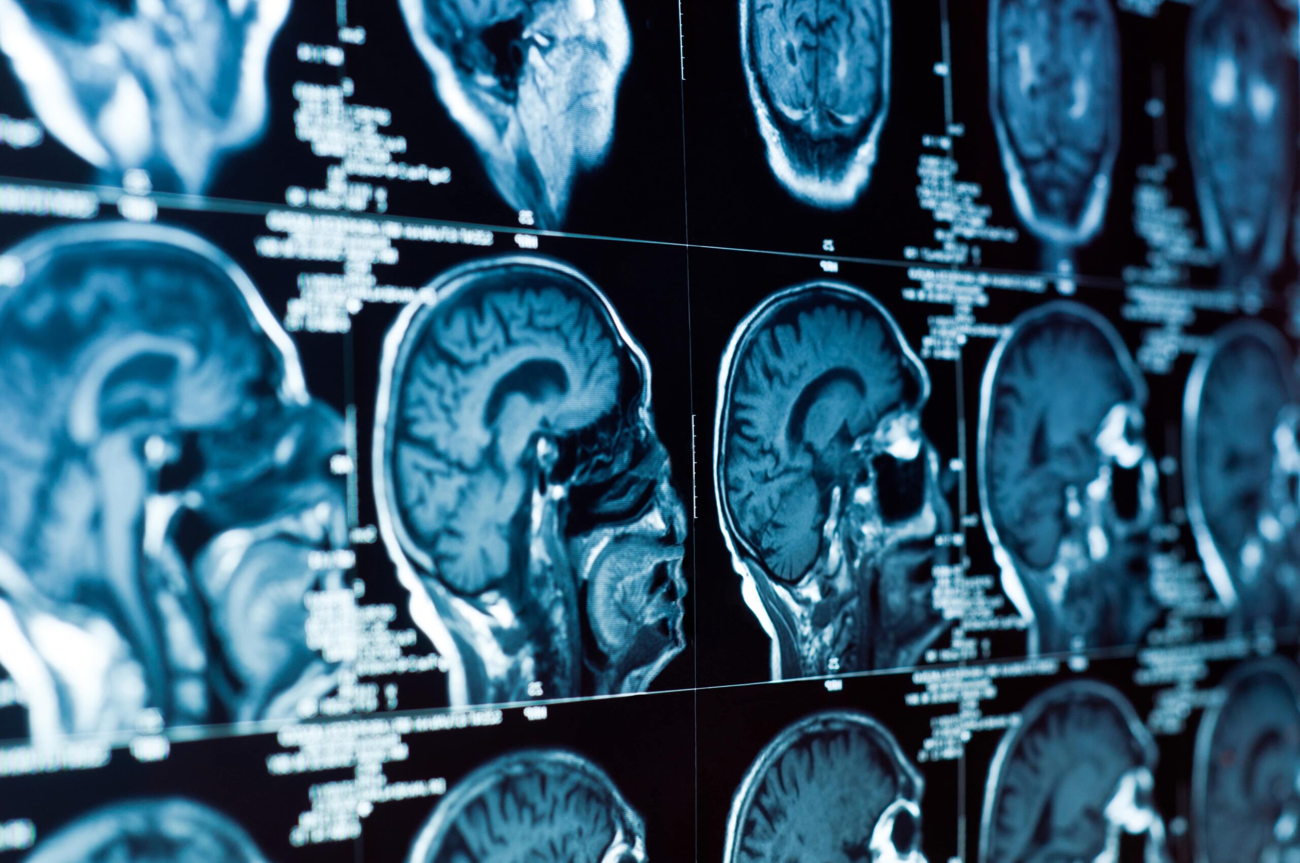 Read more about the article Legal Considerations For Traumatic Brain Injury Rehabilitation